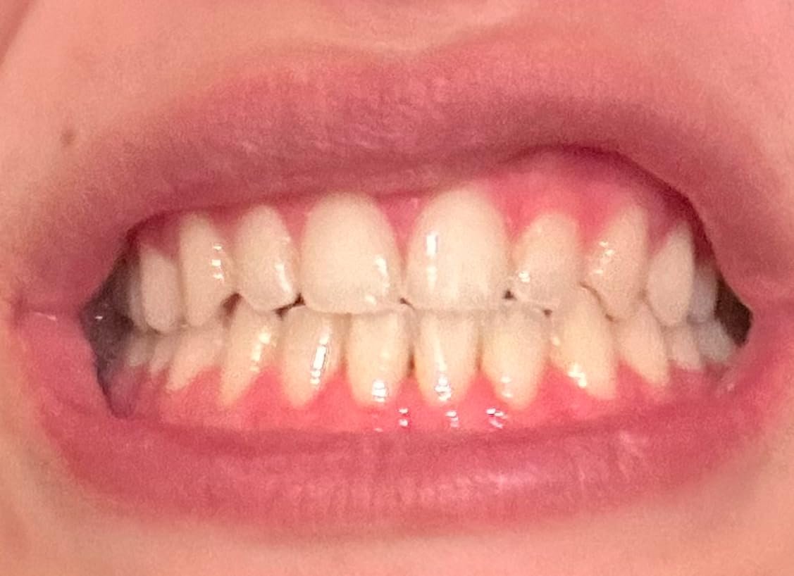 GuruNanda Professional Teeth Whitening Wireless Kit with LED Light & Whitening Pen, Helps Remove Surface Stains from Coffee, Food, Soda, 40 Treatments customer photo 1