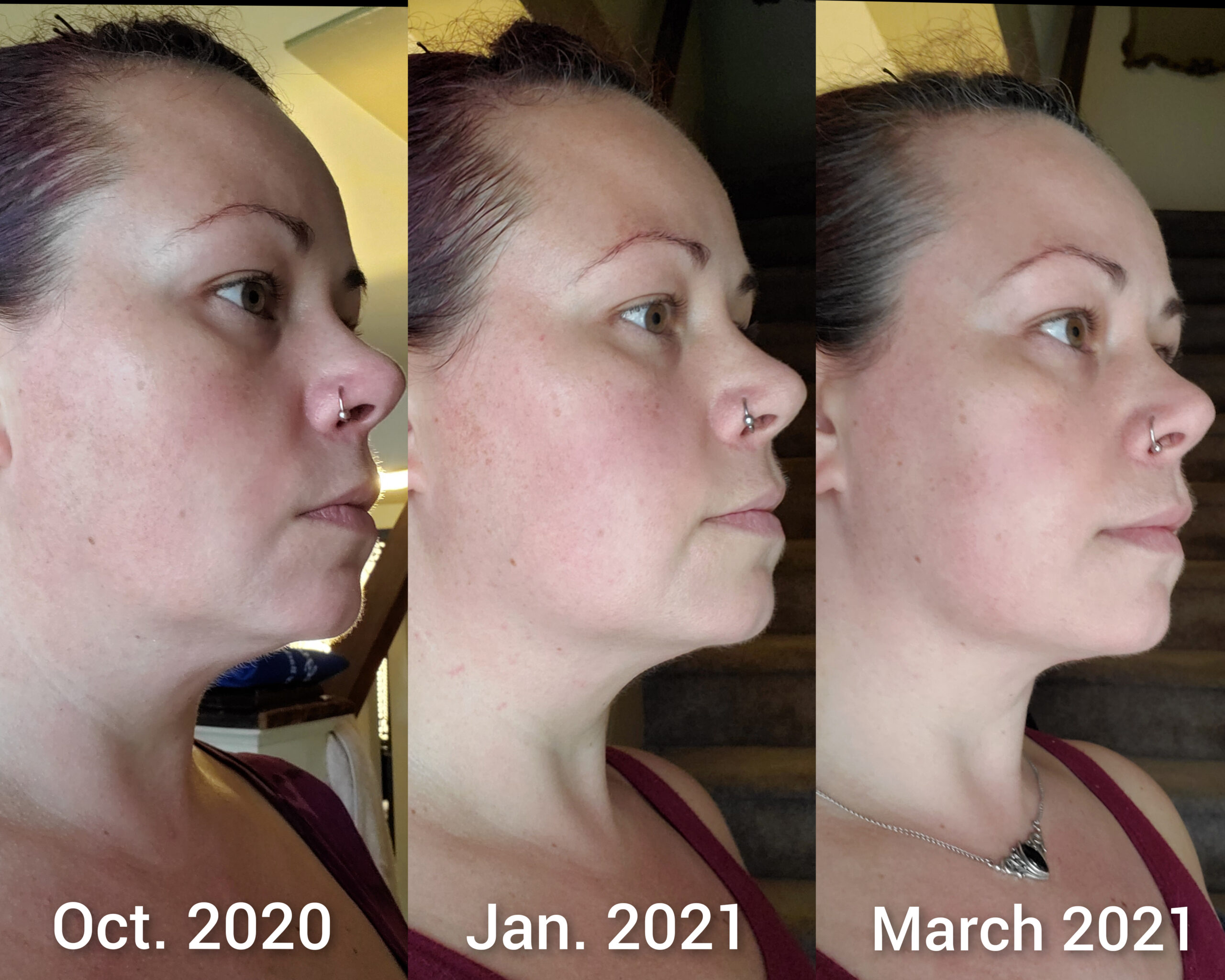 MLAY Professional RF Beauty Machine, Radio Frequency Face Machine with 2 Probes, at Home Radio Frequency Skin Tightening for Lifting, Wrinkle Reducing, Anti Aging - Salon Effects (Gel Included) customer photo 1