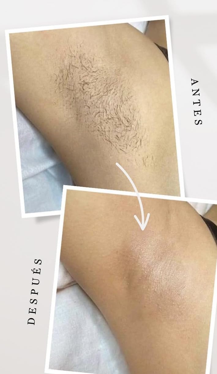 INIA Laser Hair Removal with Ice-Cooling Care for Women and Men, HAUTE Pro Painless at-Home IPL Hair Remover for Coarse Hair in Bikini All Body Areas customer photo 1